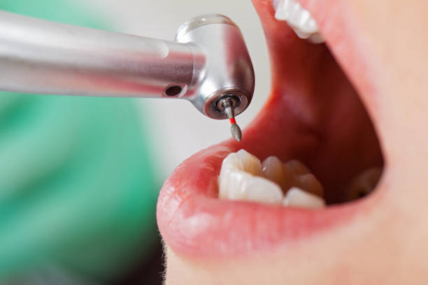 Best Emergency Tooth Extraction in Bedford, VA